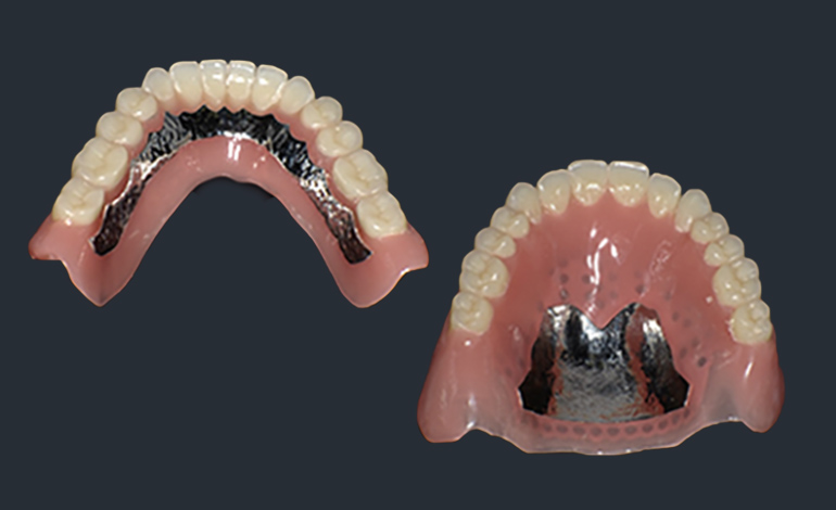 写真：金属床義歯のイメージ