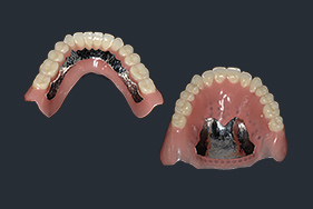写真：金属床義歯のイメージ